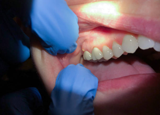 Best Emergency Broken Tooth Repair in Mount Carmel, IL