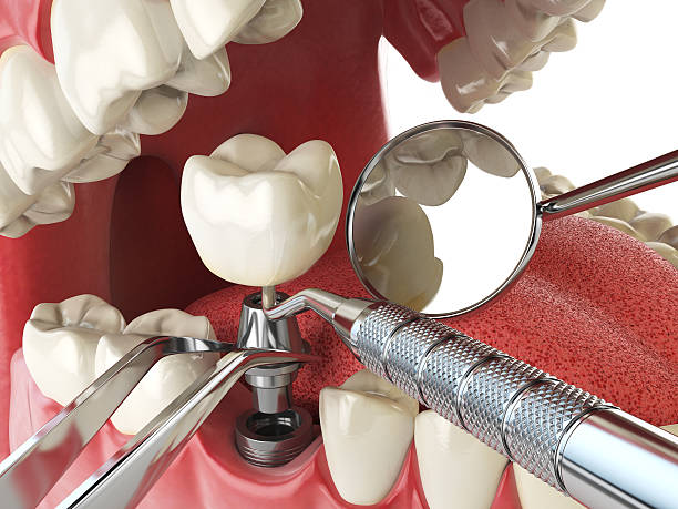 Best Emergency Tooth Extraction in Mount Carmel, IL